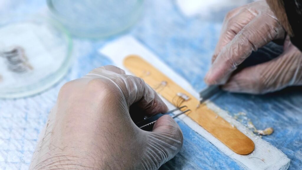 Surgeons preparing hair grafts for transplantation